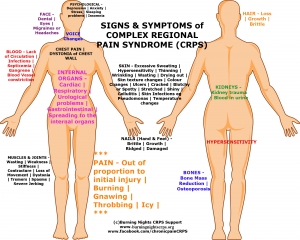 Illustration on the female human anatomy complex regional pain syndrome