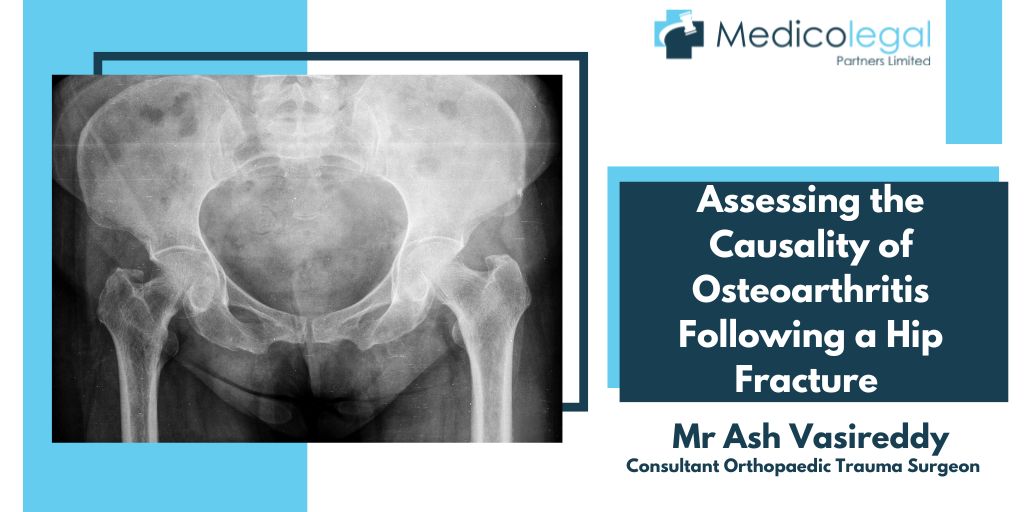 osteoarthritis-causality
